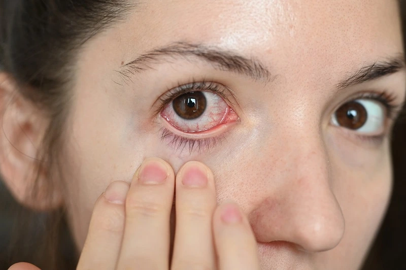 Mengenal 8 Penyebab Mata Merah dan Cara Mengatasinya