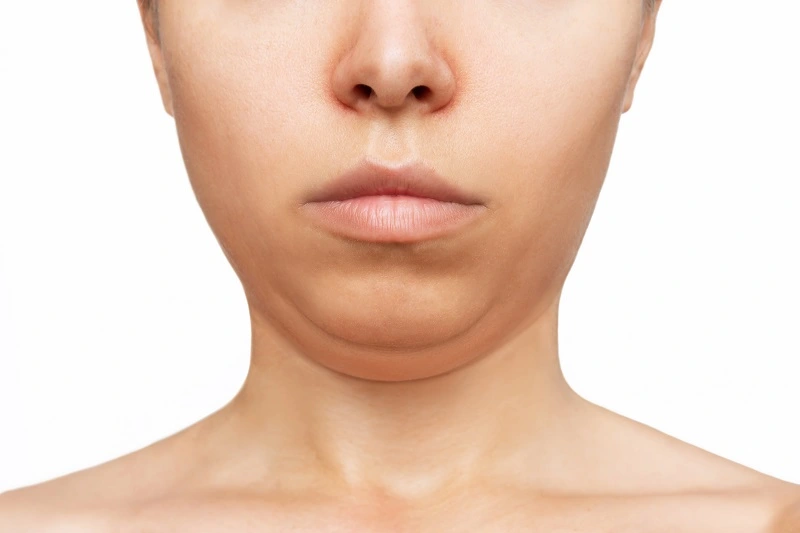 The Double Chin Dilemma: Practical Solutions for a More Defined Jawline