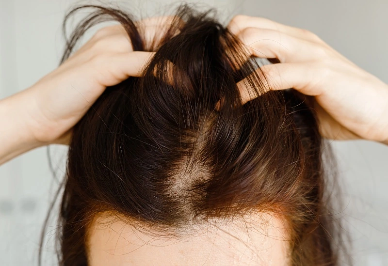 Ringworm of The Scalp (Tinea Capitis) - Causes, Symptoms And Remedies